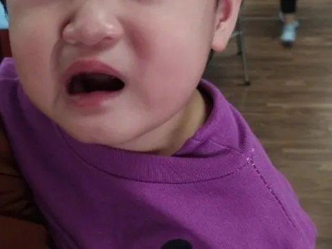 Bé 2 tuổi tuổi méo miệng, liệt dây thần kinh số 7 do trời rét đậm, rét hại