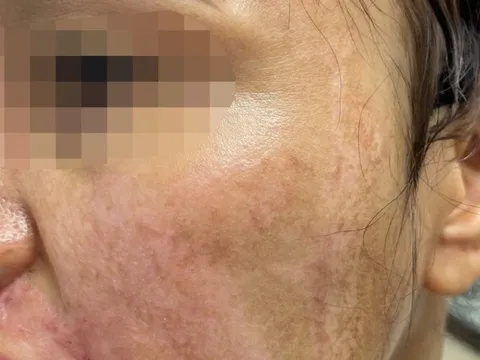 Hà Nội: Người phụ nữ bị bỏng nặng do trị nám không đúng cách