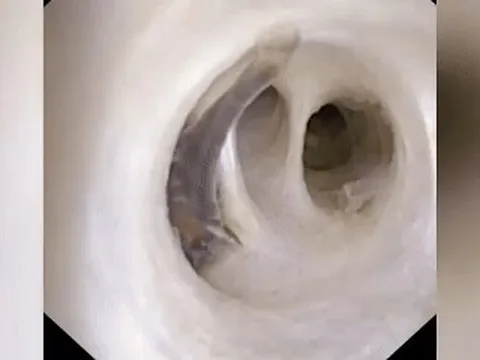 Đến bệnh viện nội soi, bác sĩ sốc nặng khi thứ trong bụng cụ ông