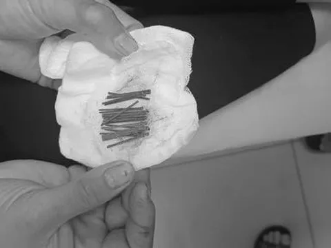 Cấp cứu bé trai nuốt 23 chiếc đinh ghim