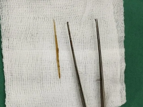 Một cô gái bị thủng ruột non do nuốt phải tăm tre