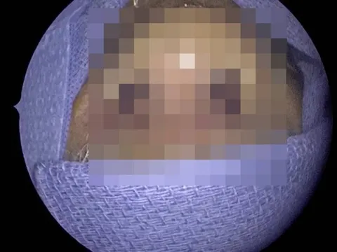 Đau mũi đi khám, bác sĩ sốc nặng khi thấy thứ trong mũi người đàn ông