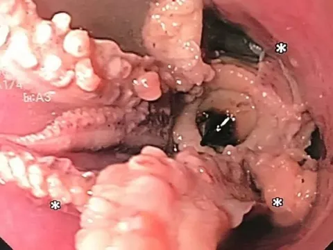 Khó nuốt đi khám, bác sĩ sốc nặng khi thấy thứ trong cổ người đàn ông