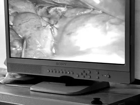 Nữ bệnh nhân thủng ruột do lạm dụng thuốc đau khớp mua trên mạng