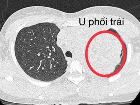 Đi khám vì đau bả vai, người phụ nữ trẻ mắc ung thư phổi