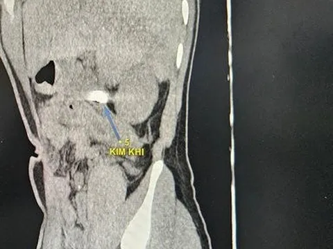 Hy hữu mắt xích máy cưa nằm trong ổ bụng bệnh nhân hơn 2 tuần