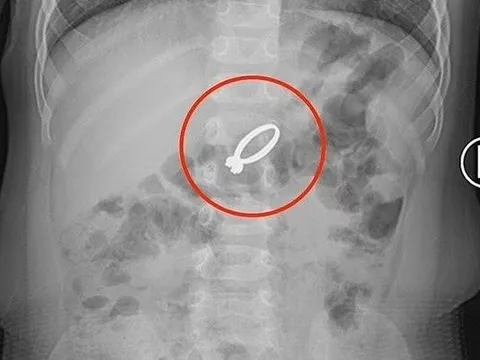 Con gái nôn mửa suốt 11 giờ, mẹ sốc nặng khi nhìn kết quả chụp X-quang