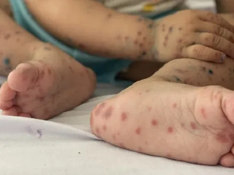 Tp.HCM: Dịch bệnh tay chân miệng gia tăng, người dân cần làm gì?