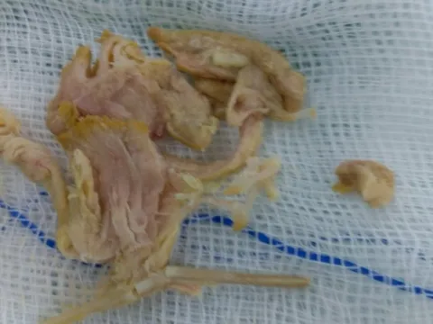 Cần Thơ: Cứu cụ ông hóc xương gà nguy kịch