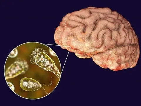 Bệnh nhi 10 tháng tuổi nguy kịch: Cảnh báo sử dụng nguồn nước bẩn, nguy cơ ký sinh trùng ăn não tấn công