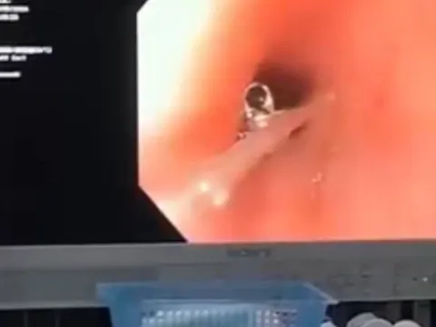 Cấp cứu bé 4 tuổi nuốt phải cúc áo