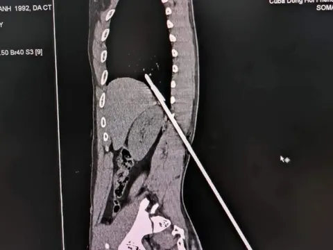 Cứu người đàn ông bị mũi tên bằng thép đâm xuyên lưng lên phổi