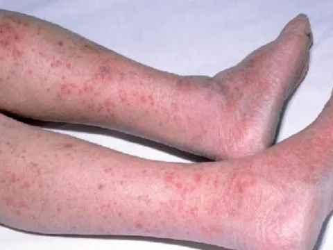 Hà Nội đã có ca mắc viêm não mô cầu, bác sĩ chỉ rõ dấu hiệu nhận biết bệnh