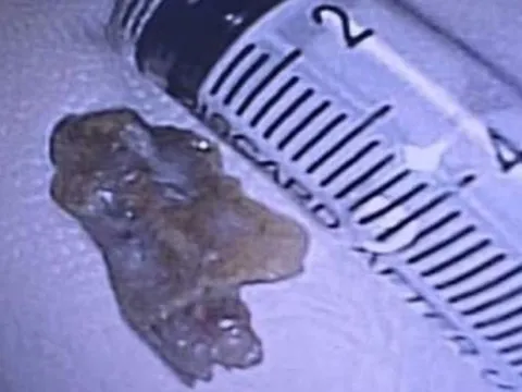 Lấy mảnh xương dài 2,5cm mắc trong phế quản bệnh nhân suốt 3 năm