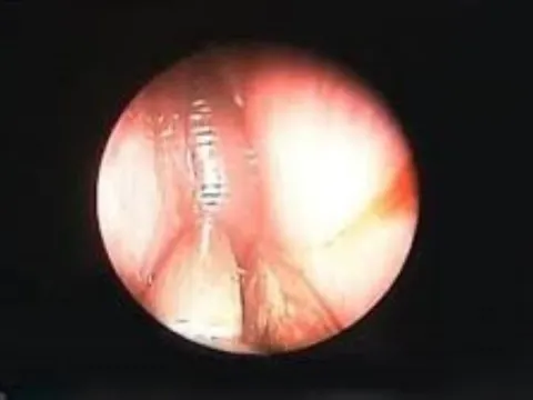 Bé trai 7 tuổi bị vắt chui vào mũi khi tắm suối